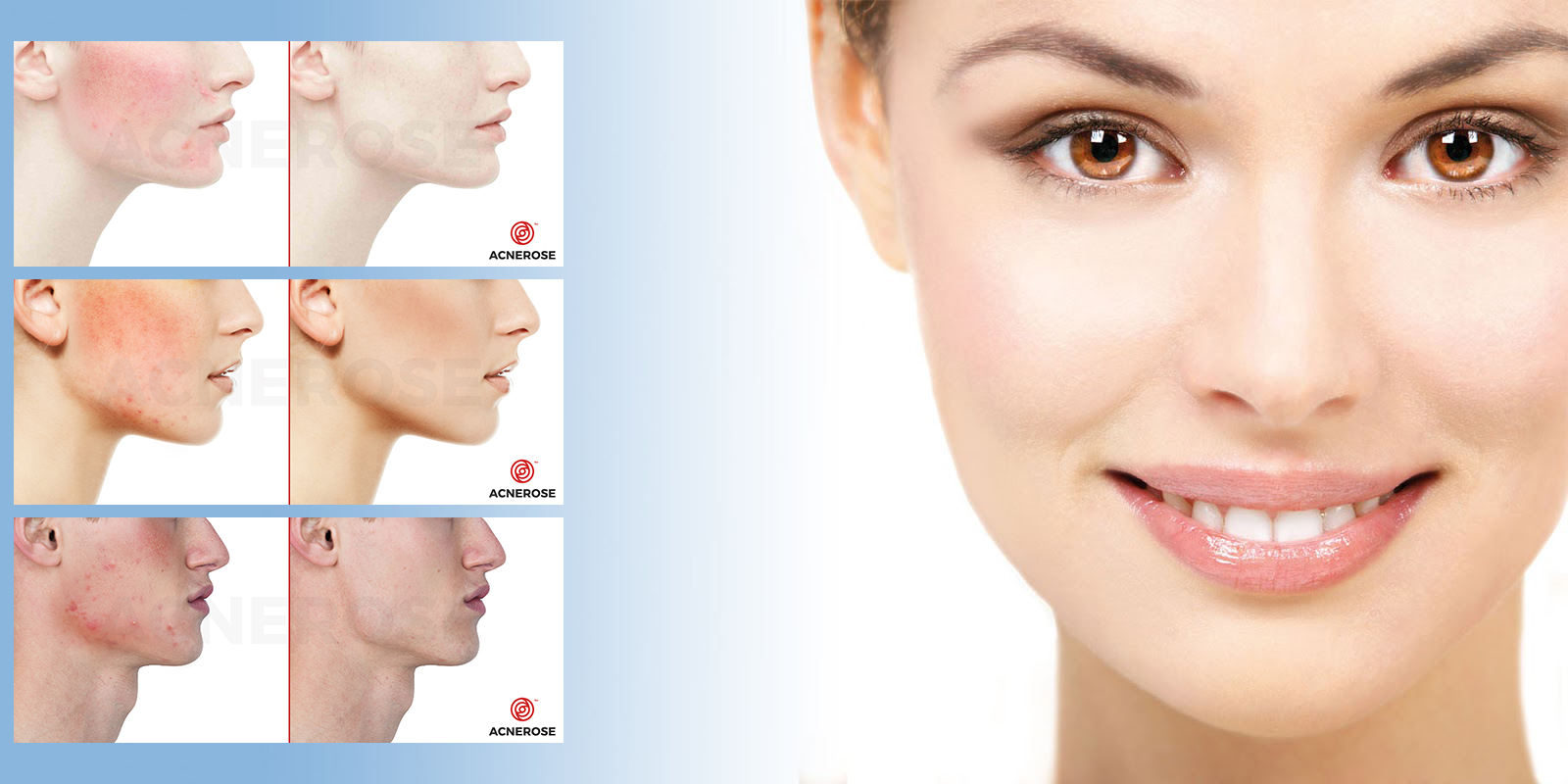 Dermokosmetyki na trądzik różowaty – jak działają?